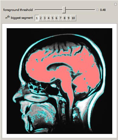 Segmenting a Medical Image